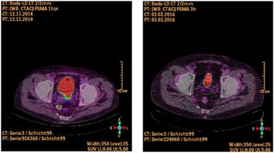 Mesorectal Lymph Node Metastases as Index Lesion in 68Ga-PSMA-PET/CT Imaging for Recurrent Prostate Cancer